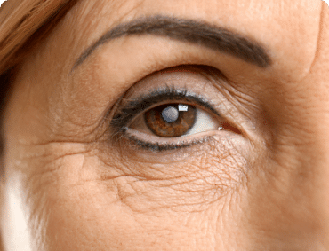 Mature woman with Cataract