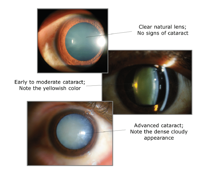 Sample images of Cataracts