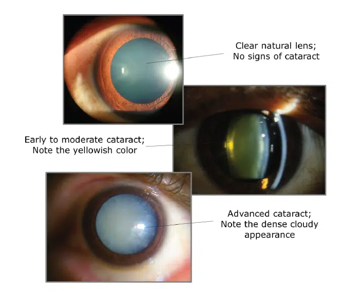 Sample images of Cataracts
