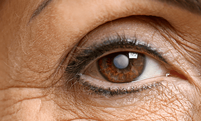 An example of an eye having a cataract
