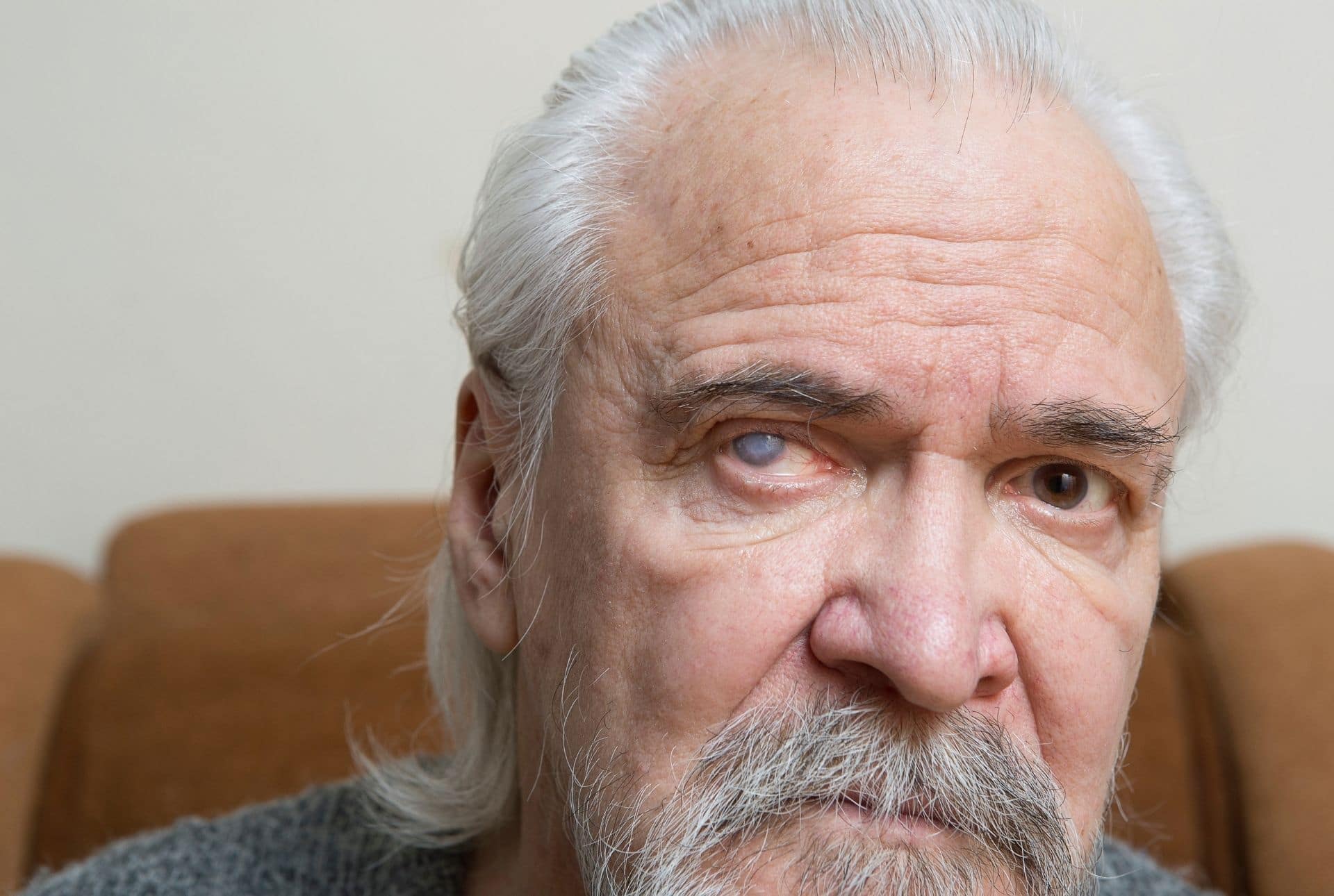 A mature man with a cataract on his left eye