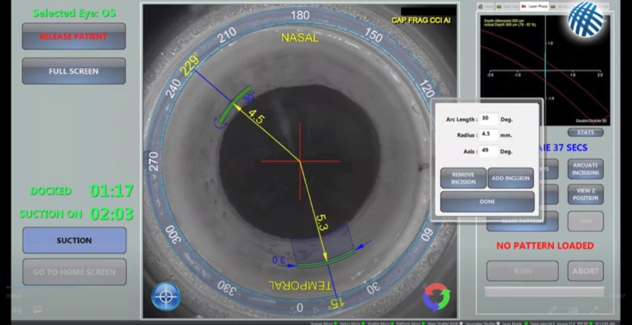 Laser cataract system that can change the shape of the cornea to treat astigmatism