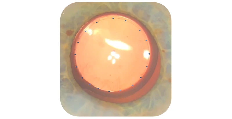 Lens positioned following laser cataract-surgery
