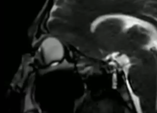 MRI of person rubbing their eyes
