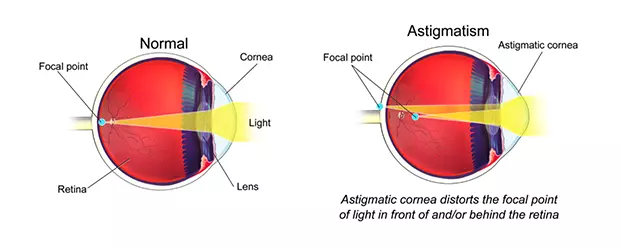 What is Astigmatism - Answers by the Best Cataract Surgeons