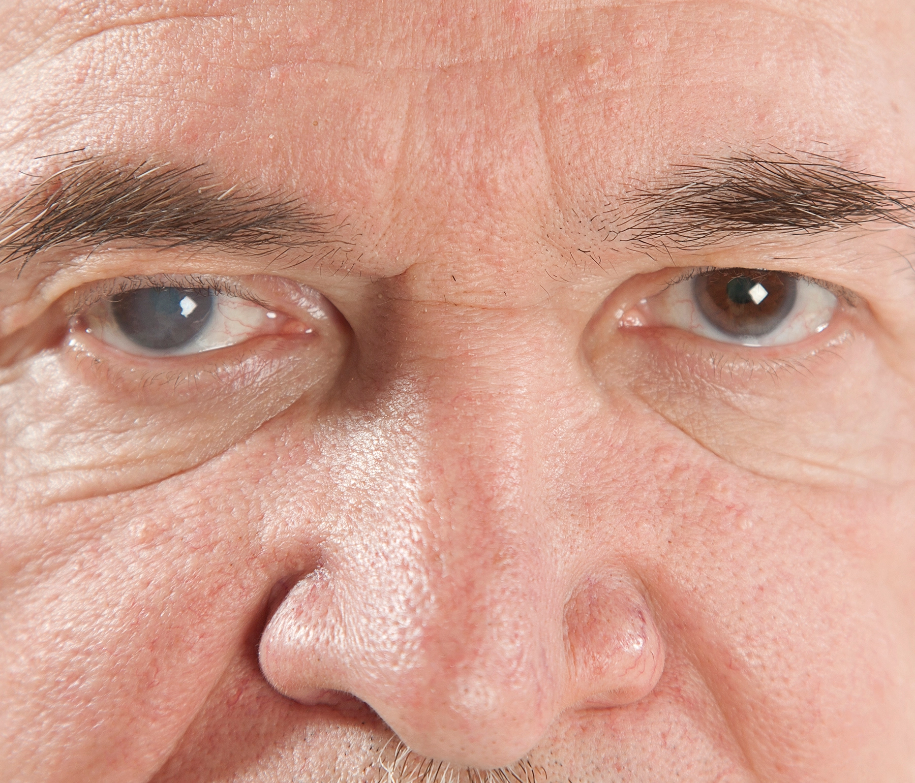 Close-up of man's eye showing blurry vision after cataract surgery