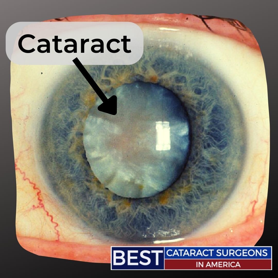 Cataract Close-Up