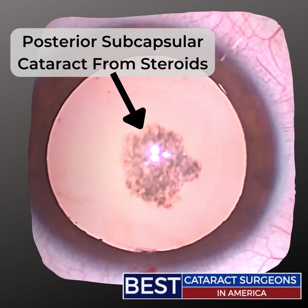 Posterior Subcapsular Cataract from steroids