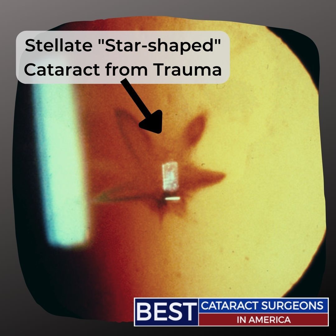 Stellate Star-Shaped Cataract from trauma
