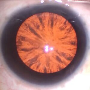 Cortical Cataract