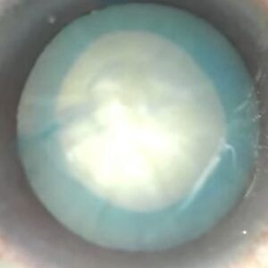 Mature Cortical Cataract