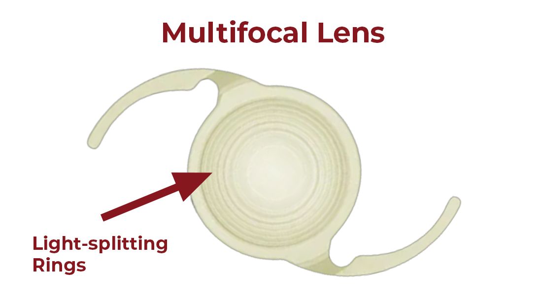 Multifocal Lens Implant