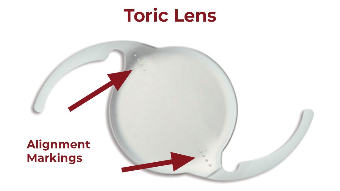 Toric Lens Implant