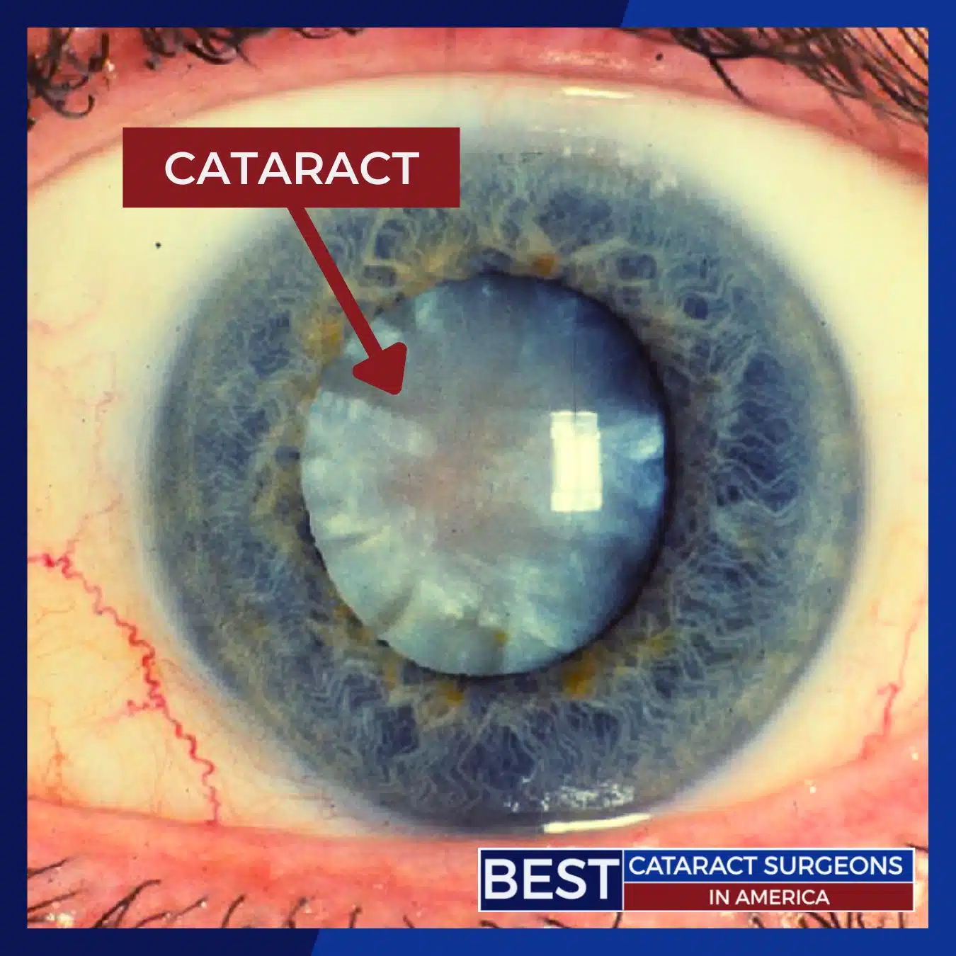 Cataract Close-Up