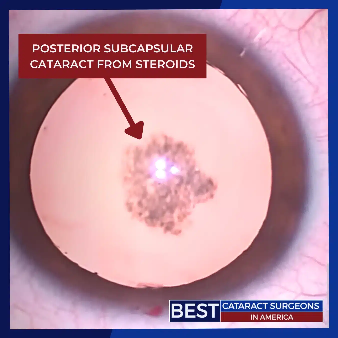 Posterior subcapsular cataract from steroids