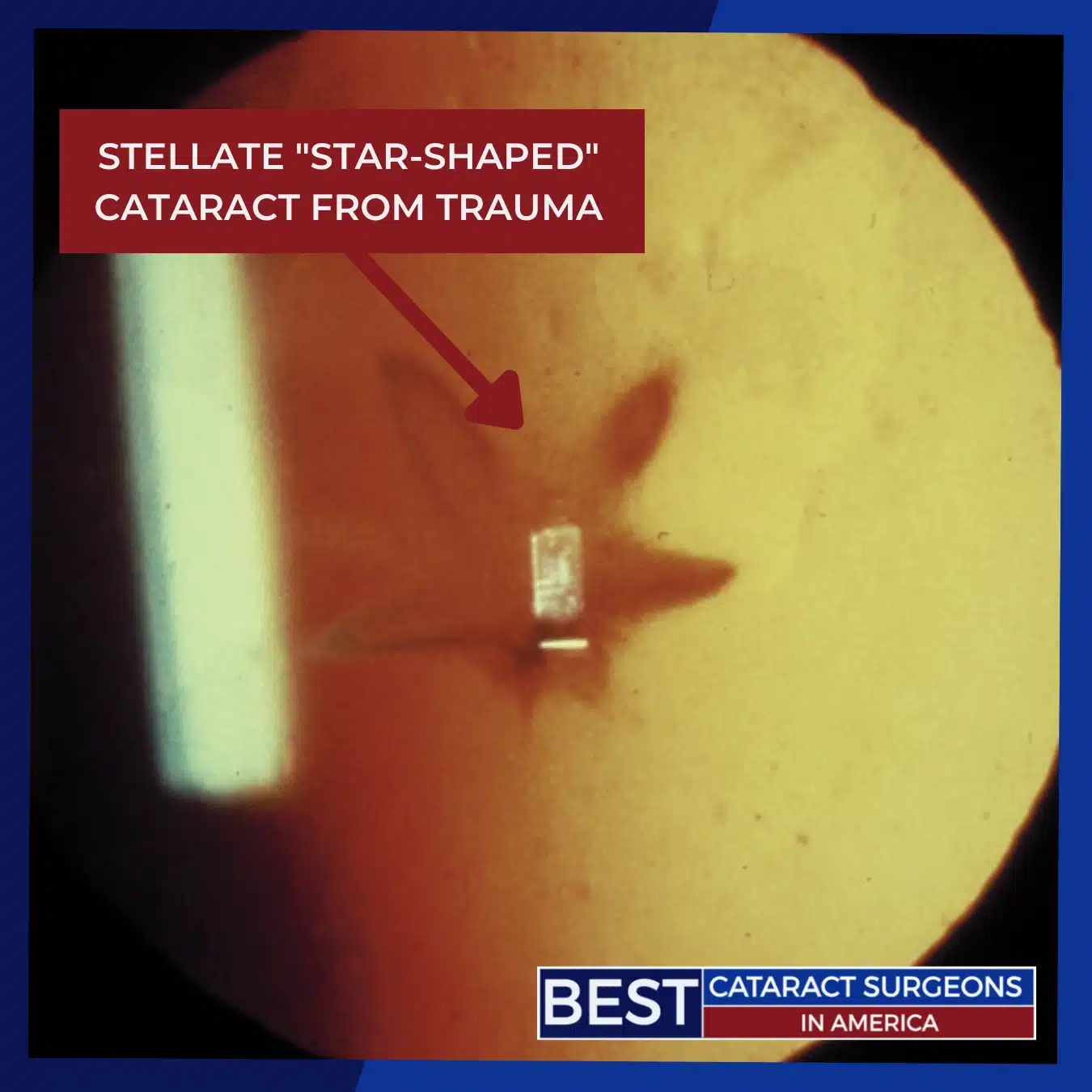 Stellate Star-shaped Cataract from Trauma