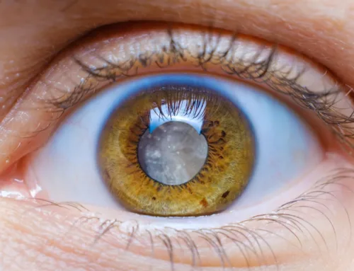 All About Senile Cataracts | Patient Guide